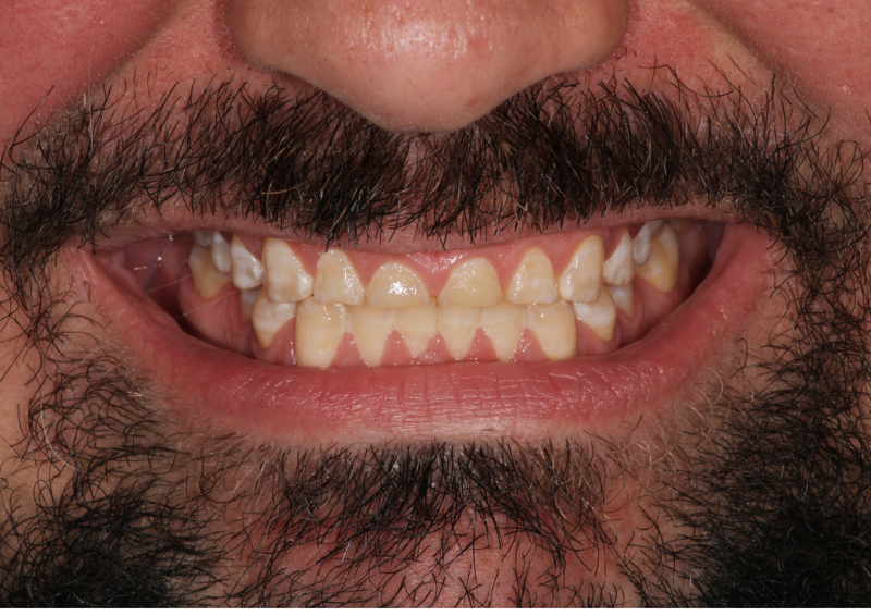 Antes