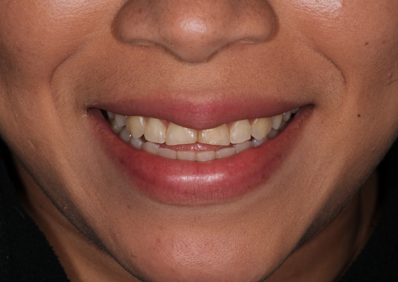 Antes